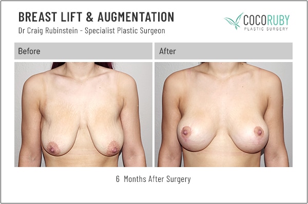 dr-craig-rubinstein-breast lift before and after photos